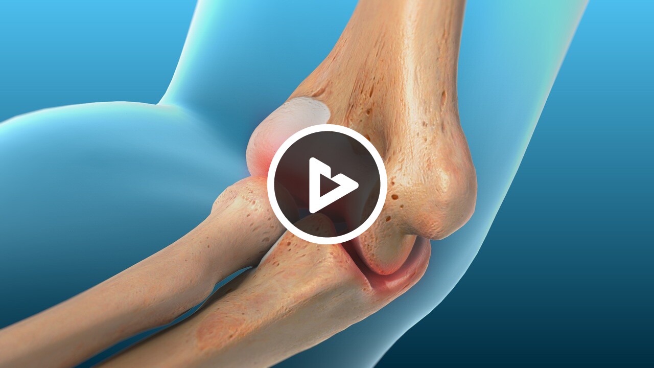Throwing Injuries of the Elbow - Hand, Wrist & Elbow - Willis Knighton ...